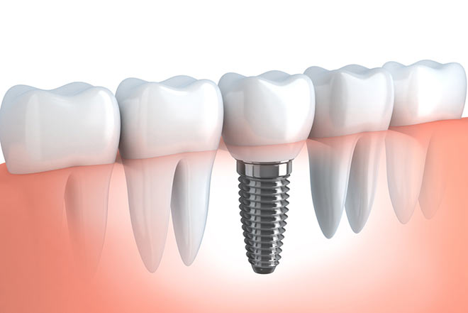 Dentista empaste