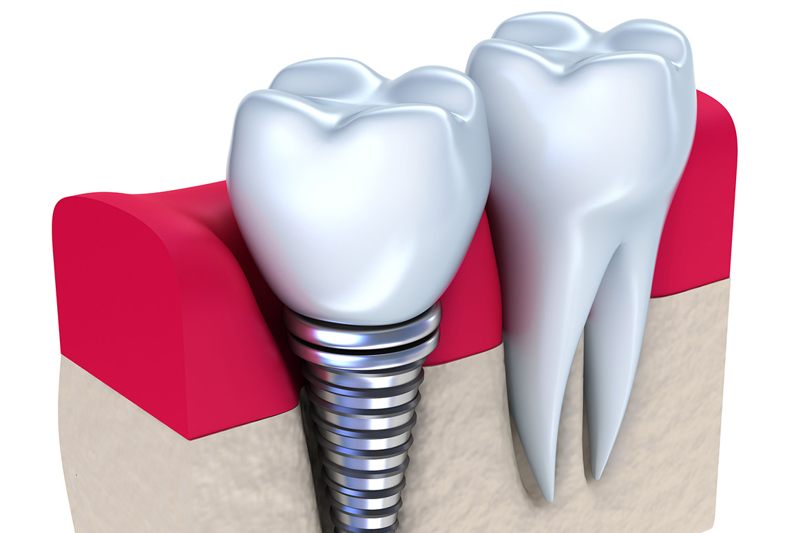 implantes dentales