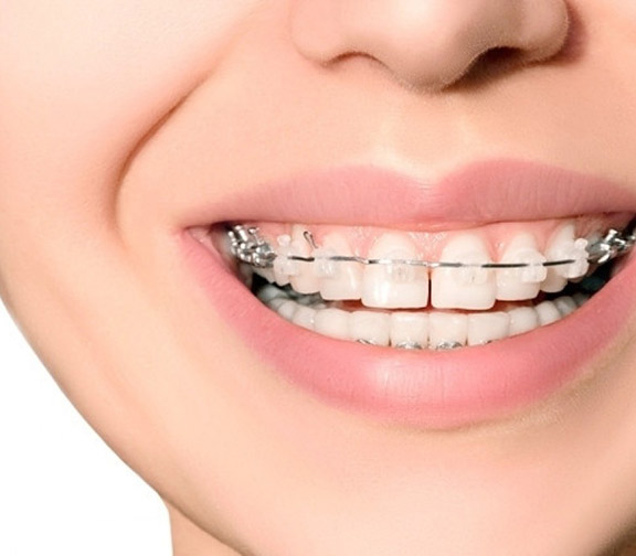 Brackets